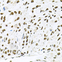 Immunohistochemistry of paraffin-embedded Human lung cancer using JNK1 Polyclonal Antibody at dilution of 1:100 (40x lens) .