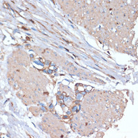 Immunohistochemistry of paraffin-embedded Human gastric cancer using CD44 Polyclonal Antibody at dilution of 1:200 (40x lens) .