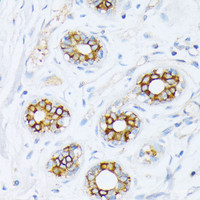 Immunohistochemistry of paraffin-embedded Human breast cancer using Fatty Acid Synthase Polyclonal Antibody at dilution of 1:200 (40x lens) .
