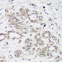 Immunohistochemistry of paraffin-embedded Human breast cancer using NRF2 Polyclonal Antibody at dilution of 1:100 (40x lens) .