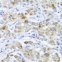 Immunohistochemistry of paraffin-embedded Human liver cancer using SOCS3 Polyclonal Antibody at dilution of 1:100 (40x lens) .