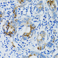 Immunohistochemistry of paraffin-embedded Human gastric cancer using MMP7 Polyclonal Antibody at dilution of 1:100 (40x lens) .