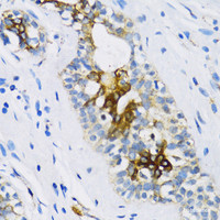 Immunohistochemistry of paraffin-embedded Human breast using PTCH1 Polyclonal Antibody at dilution of 1:100 (40x lens) .
