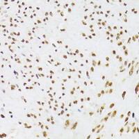 Immunohistochemistry of paraffin-embedded Human leiomyoma of uterus using KU70 Polyclonal Antibody at dilution of 1:100 (40x lens) .