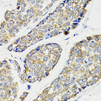 Immunohistochemistry of paraffin-embedded Human esophageal cancer using IKBKG Polyclonal Antibody at dilution of 1:100 (40x lens) .