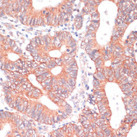 Immunohistochemistry of paraffin-embedded Human colon carcinoma using TIAM1 Polyclonal Antibody at dilution of 1:100 (40x lens) .