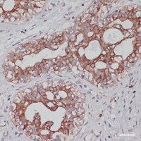 Immunohistochemistry of paraffin-embedded Human mammary cancer using TPD52 Polyclonal Antibody at dilution of 1:100 (40x lens) .