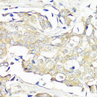 Immunohistochemistry of paraffin-embedded Human breast cancer using EIF3B Polyclonal Antibody at dilution of 1:100 (40x lens) .