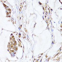 Immunohistochemistry of paraffin-embedded Human gastric cancer using EGLN1/EGLN2 Polyclonal Antibody at dilution of 1:100 (40x lens) .