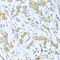 Immunohistochemistry of paraffin-embedded Human gastric cancer using KLHL42 Polyclonal Antibody at dilution of 1:100 (40x lens) .