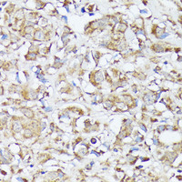 Immunohistochemistry of paraffin-embedded Human mammary cancer using MTHFD2 Polyclonal Antibody at dilution of 1:100 (40x lens) .