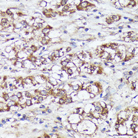 Immunohistochemistry of paraffin-embedded Human liver cancer using MTHFD2 Polyclonal Antibody at dilution of 1:100 (40x lens) .