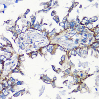 Immunohistochemistry of paraffin-embedded Human lung cancer using MMP16 Polyclonal Antibody at dilution of 1:100 (40x lens) .