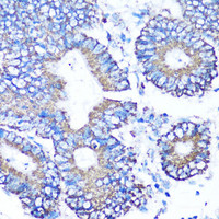 Immunohistochemistry of paraffin-embedded Human colon carcinoma using MMP16 Polyclonal Antibody at dilution of 1:100 (40x lens) .