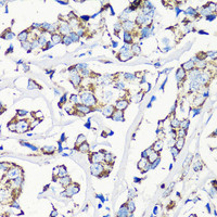 Immunohistochemistry of paraffin-embedded Human breast cancer using MMP16 Polyclonal Antibody at dilution of 1:100 (40x lens) .