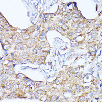 Immunohistochemistry of paraffin-embedded Human breast cancer using CTSF Polyclonal Antibody at dilution of 1:100 (40x lens) .