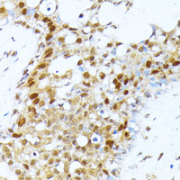 Immunohistochemistry of paraffin-embedded Human breast cancer using PRMT1 Polyclonal Antibody at dilution of 1:100 (40x lens) .