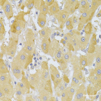 Immunohistochemistry of paraffin-embedded Human liver cancer using Slug Polyclonal Antibody at dilution of 1:100 (40x lens) .