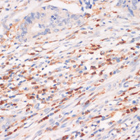 Immunohistochemistry of paraffin-embedded Human colon carcinoma using CYBA Polyclonal Antibody at dilution of 1:100 (40x lens) .