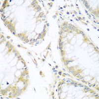 Immunohistochemistry of paraffin-embedded Human gastric cancer using CUL3 Polyclonal Antibody at dilution of 1:100 (40x lens) .