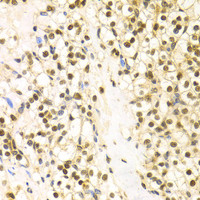 Immunohistochemistry of paraffin-embedded Human kidney cancer using BAG1 Polyclonal Antibody at dilution of 1:100 (40x lens) .