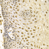 Immunohistochemistry of paraffin-embedded Human esophageal cancer using BAG1 Polyclonal Antibody at dilution of 1:100 (40x lens) .