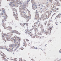 Immunohistochemistry of paraffin-embedded Human lung cancer using CREB1 Polyclonal Antibody at dilution of 1:100 (40x lens) .