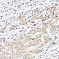 Immunohistochemistry of paraffin-embedded Human liver cancer using IGFBP1 Polyclonal Antibody at dilution of 1:100 (40x lens) .