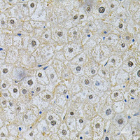 Immunohistochemistry of paraffin-embedded Human liver damage using SQSTM1 / p62 Polyclonal Antibody at dilution of 1:200 (40x lens) .