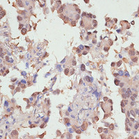 Immunohistochemistry of paraffin-embedded Human lung cancer using YAP1 Polyclonal Antibody at dilution of 1:100 (40x lens) .