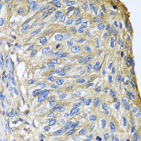 Immunohistochemistry of paraffin-embedded Human prostate cancer using APOA1 Polyclonal Antibody at dilution of 1:100 (40x lens) .