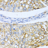 Immunohistochemistry of paraffin-embedded Human prostate cancer using BMP4 Polyclonal Antibody at dilution of 1:100 (40x lens) .