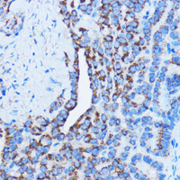 Immunohistochemistry of paraffin-embedded Human thyroid cancer using DDIT3 / CHOP Polyclonal Antibody at dilution of 1:100 (40x lens) .