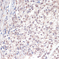 Immunohistochemistry of paraffin-embedded Human gastric cancer using c-Jun Polyclonal Antibody at dilution of 1:100 (40x lens) .