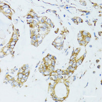 Immunohistochemistry of paraffin-embedded Human gastric cancer using EGFR Polyclonal Antibody at dilution of 1:100 (40x lens) .