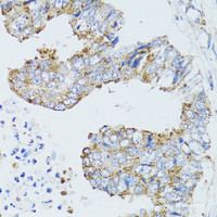 Immunohistochemistry of paraffin-embedded Human rectal cancer using EGFR Polyclonal Antibody at dilution of 1:100 (40x lens) .