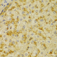 Immunohistochemistry of paraffin-embedded Human liver cancer using ACTN1 Polyclonal Antibody at dilution of 1:100 (40x lens) .