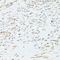 Immunohistochemistry of paraffin-embedded Human uterine cancer using TRIM15 Polyclonal Antibody at dilution of 1:100 (40x lens) .