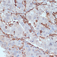 Immunohistochemistry of paraffin-embedded Human liver cancer using HLA-DRA Polyclonal Antibody at dilution of 1:100 (40x lens) .