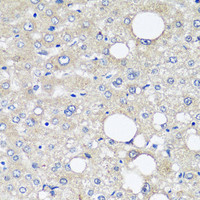 Immunohistochemistry of paraffin-embedded Human liver cancer using AFP Monoclonal Antibody at dilution of 1:12.5 (40x lens) .