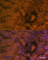 Immunofluorescence analysis of Human liver cancer using AFP Monoclonal Antibody at dilution of 1:100. Blue: DAPI for nuclear staining.