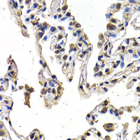 Immunohistochemistry of paraffin-embedded Human lung cancer using FIGF Polyclonal Antibody at dilution of 1:200 (40x lens) .