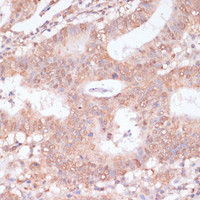 Immunohistochemistry of paraffin-embedded Human colon carcinoma using BYSL Polyclonal Antibody at dilution of 1:100 (40x lens) .