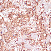Immunohistochemistry of paraffin-embedded Human breast cancer using BYSL Polyclonal Antibody at dilution of 1:100 (40x lens) .