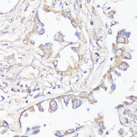 Immunohistochemistry of paraffin-embedded Human lung cancer using KL Polyclonal Antibody at dilution of 1:200 (40x lens) .