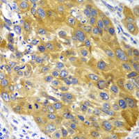 Immunohistochemistry of paraffin-embedded Human esophageal cancer using AK1 Polyclonal Antibody at dilution of 1:100 (40x lens) .