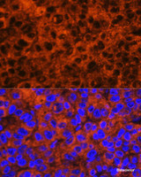 Immunofluorescence analysis of Human liver cancer using F2 Polyclonal Antibody at dilution of 1:100. Blue: DAPI for nuclear staining.