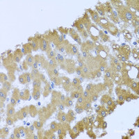 Immunohistochemistry of paraffin-embedded Human liver damage using ACP1 Polyclonal Antibody at dilution of 1:100 (40x lens) .