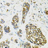 Immunohistochemistry of paraffin-embedded Human esophageal cancer using ADSS Polyclonal Antibody at dilution of 1:100 (40x lens) .