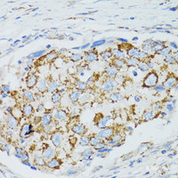 Immunohistochemistry of paraffin-embedded Human breast cancer using C1 Inactivator Polyclonal Antibody at dilution of 1:100 (40x lens) .